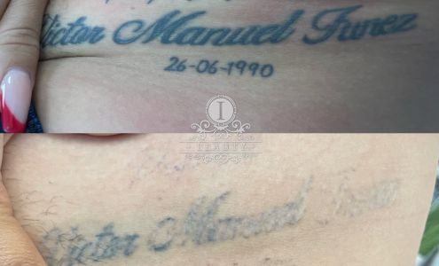 Boca Raton Laser Hair Removal and Laser Tattoo Removal iBeauty Makeover