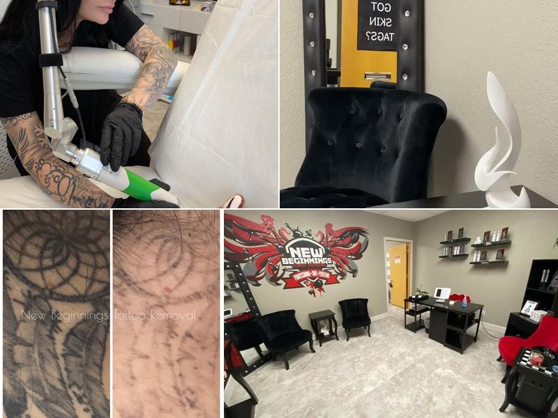 New Beginnings Tattoo Removal