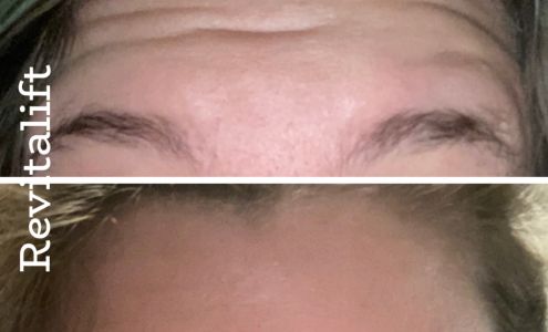 Revitalift Aesthetic Center