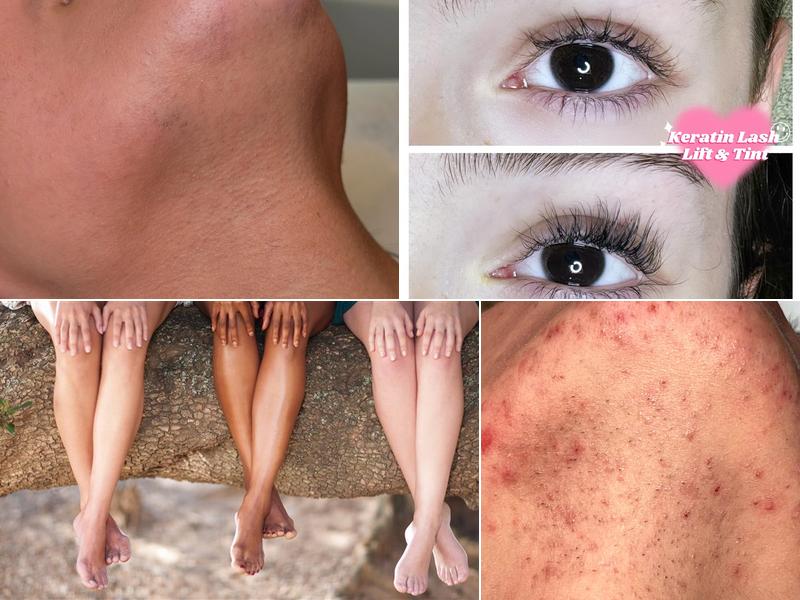 Precise Laser Hair Removal & Esthetics