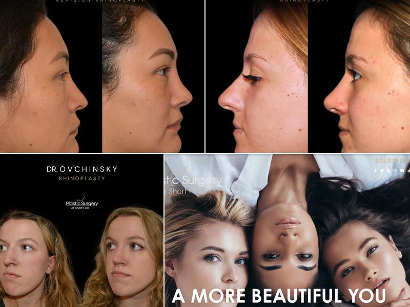 Rhinoplasty NJ: Dr. Alexander Ovchinsky