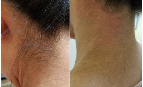 Adela Rullan Electrolysis