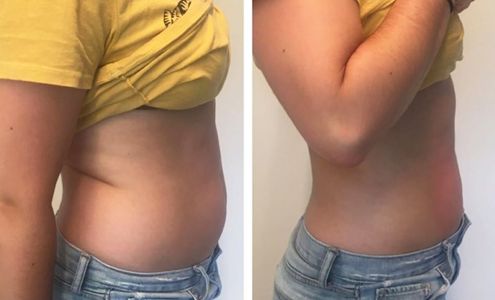 Minus 250 Degrees Cryotherapy and Massage Therapy