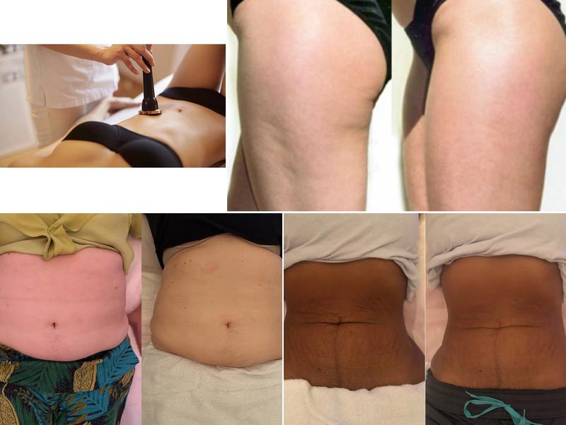 New Image Body and Face Contouring