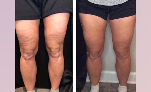 Endermologie By Kasey 838 1/2 Foothill Blvd, La Cañada Flintridge California 91011