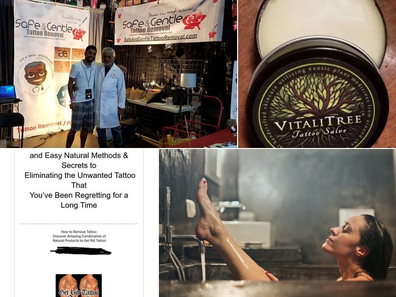 Safe and Gentle Tattoo Removal