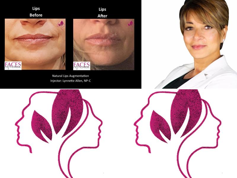 Faces Refreshed Lynnette Allen NP-C