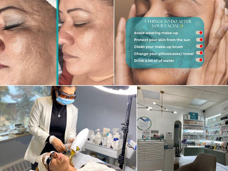 Vitality Works Medspa • Acne & Laser • Toronto