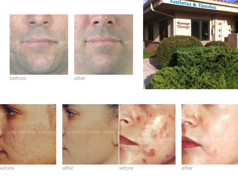 Aesthetics and Electrolysis