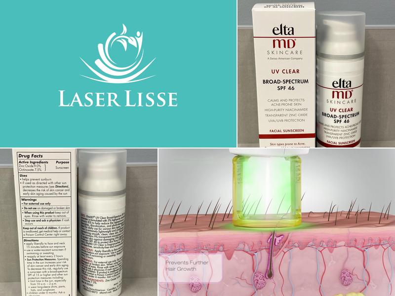 Laser Lisse: Kathleen Farrell, M.D.