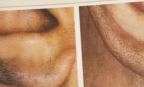 Hairaway Electrolysis-Laser