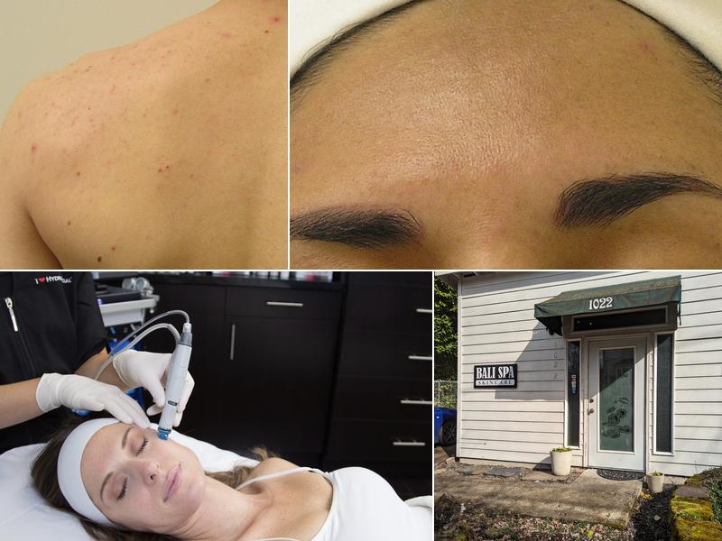 Bali Spa - Hydrafacial Experts