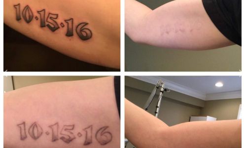 Lexington Tattoo Removal