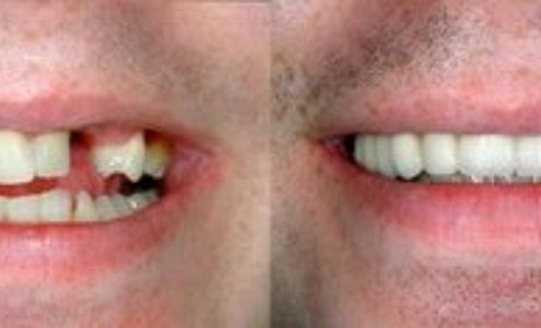 HB Dental: Herb Bennett, DMD 120 E Dixie Ave, Leesburg Florida 34748