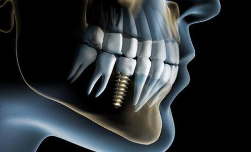 Metro West Dental & Implant Institute