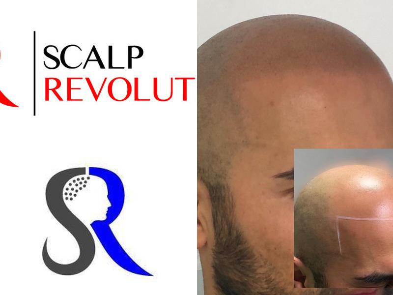 Scalp Revolution