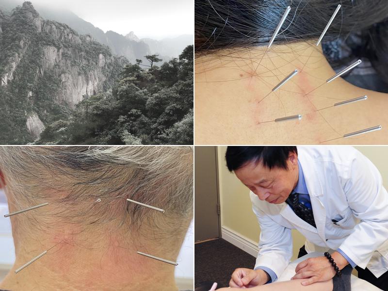 Victor Chang Acupuncture