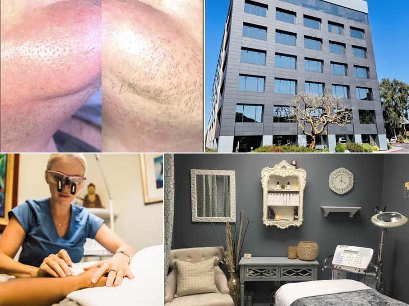 Bare Electrolysis PCOS Experts