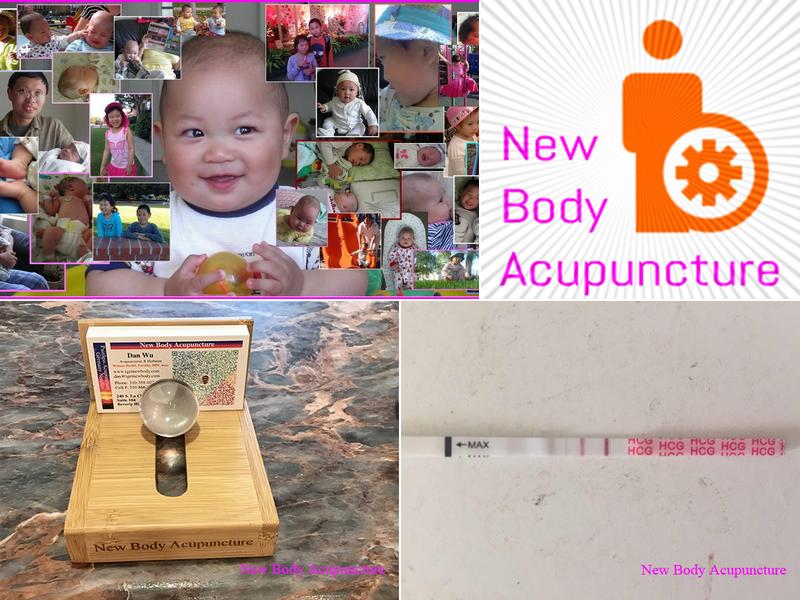 New Body Acupuncture