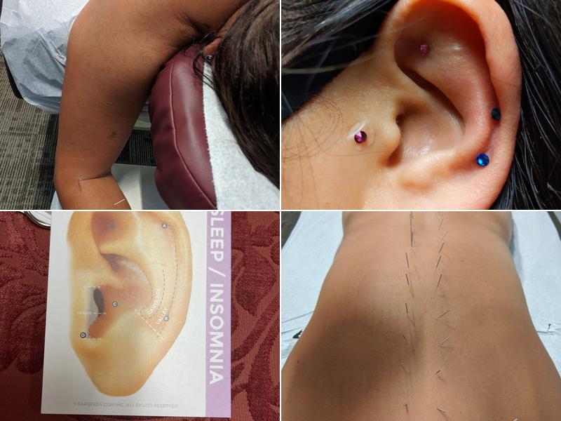 Jung Yun Acupuncture