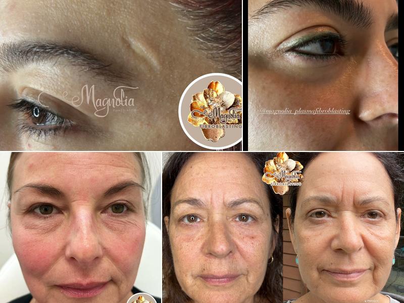 Magnolia Plasma Fibroblasting