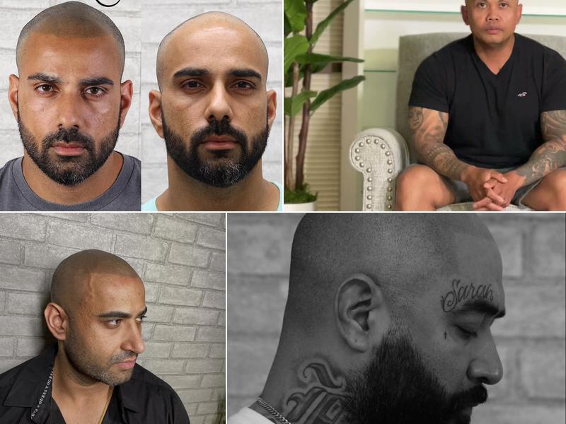 Infusion SMP Scalp Micropigmentation