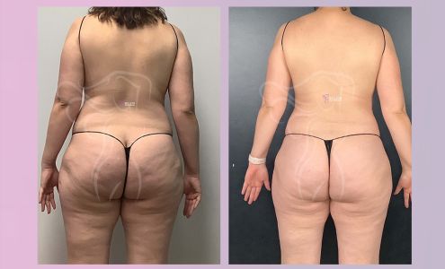 Belleza Colombiana | Body Contouring + Post Op Care/Rehab (Lymphatic drainage)