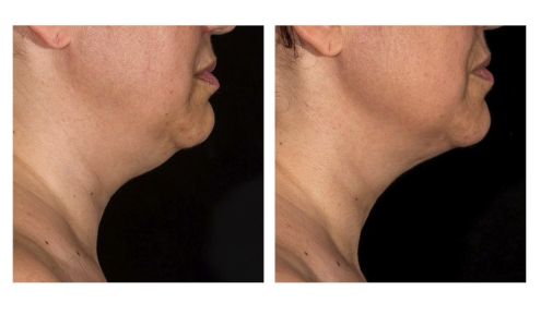 Body Sculpt Skin Laser