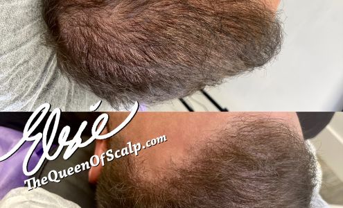 SMP Hair Clinic The Queen Of Scalp