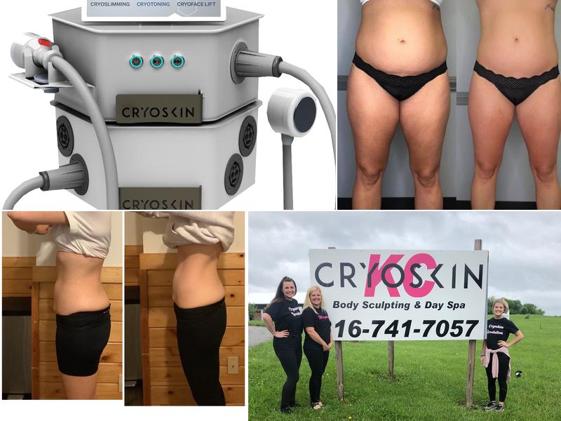 KCryoskin Body Sculpting & Cryotherapy Wellness Day Spa