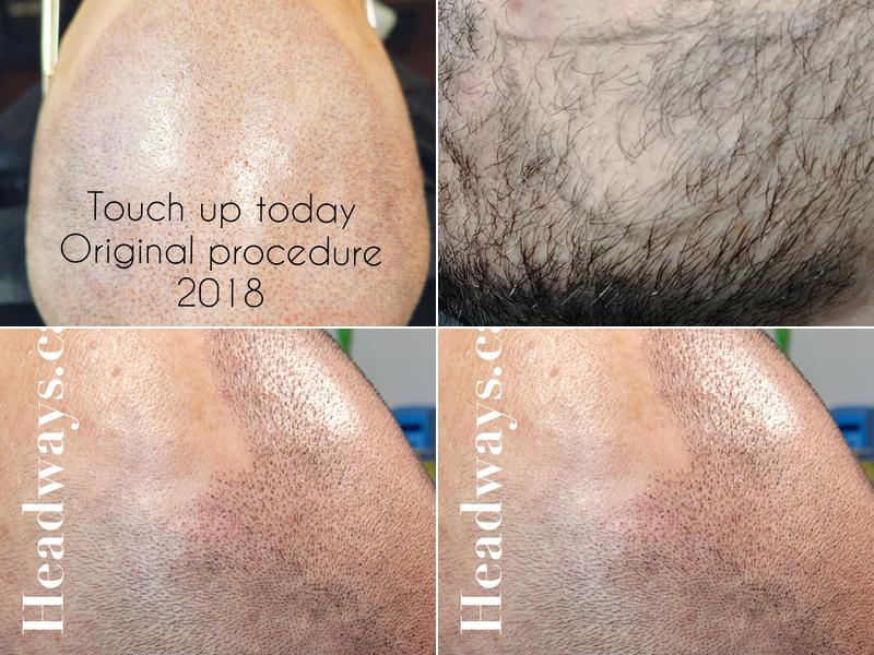 Headways Edmonton Scalp Micro-Pigmentation