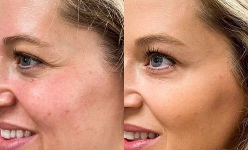 L. Britt Swor-Yim, M.D. | Facial Aesthetics | Botox, Filler, Y-Lift