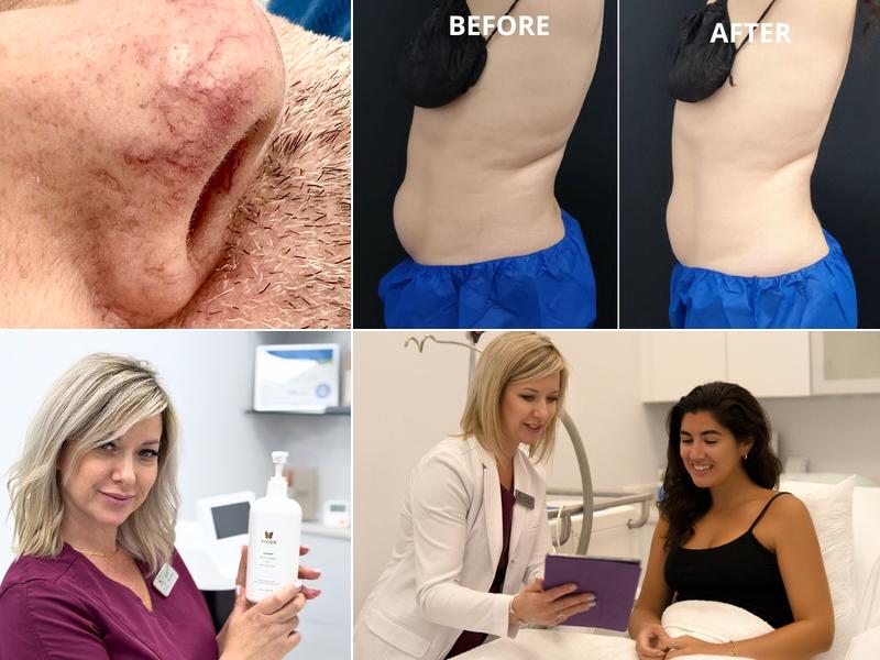 Canada MedLaser Maple