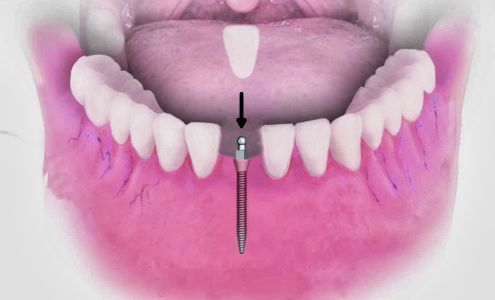 Dental Implant Solutions of The Villages FL