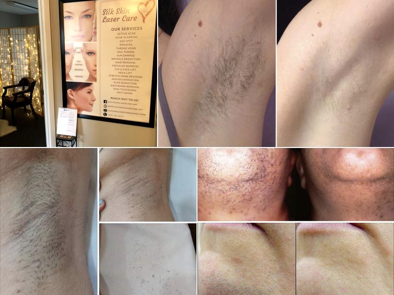 Silk Skin Laser Care