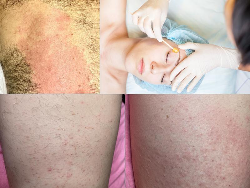 Electrolysis by Naz and Spa