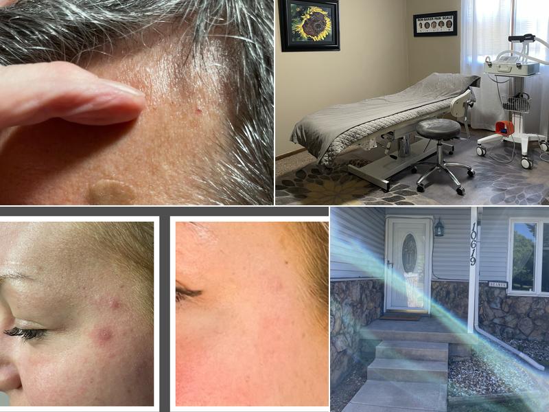 Laser beamer Skincare