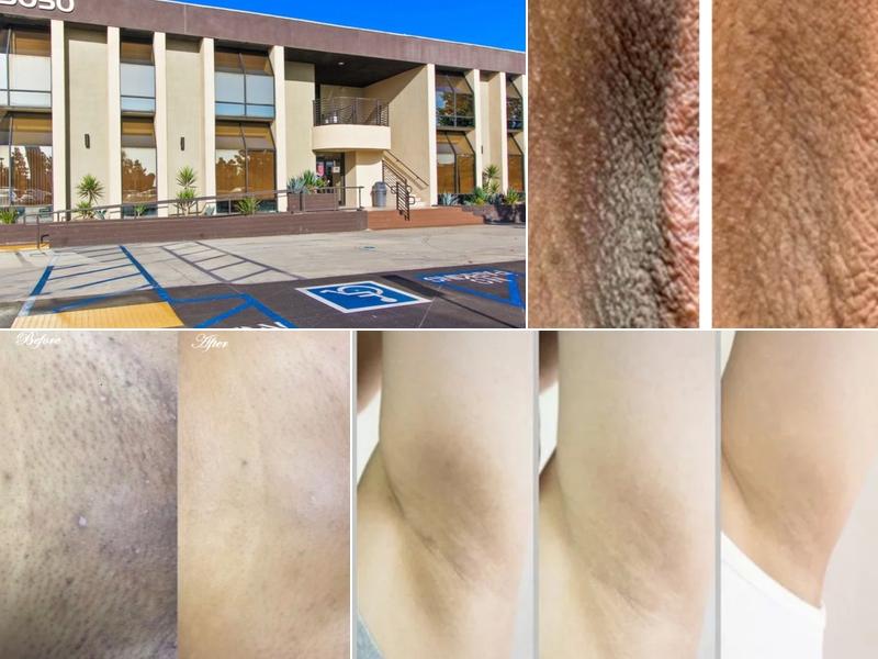 Anal and Vaginal Bleaching by V-Juvenate Spa