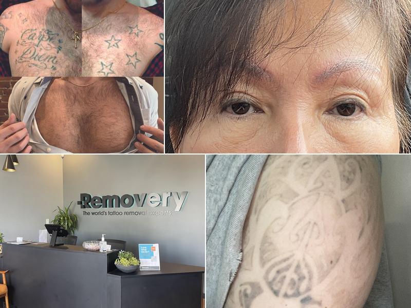 Removery Tattoo Removal & Fading