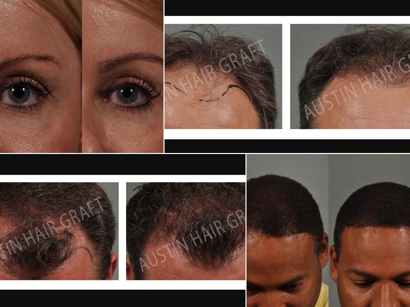 Austin Hair Graft