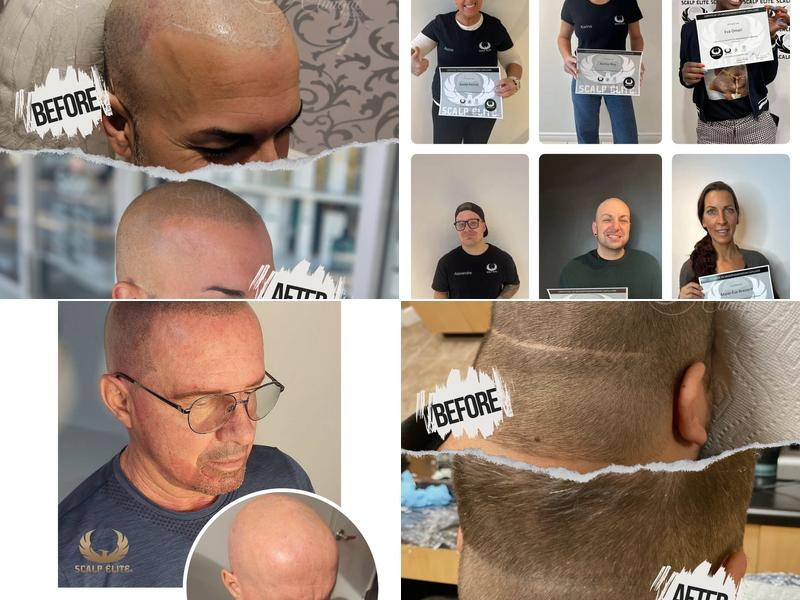 Scalp Clinique Micro