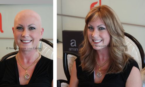 San Diego Hair Loss Center
