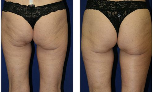 Rejuvalase MedSpa Santa Barbara