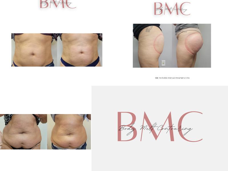 Body melt contouring