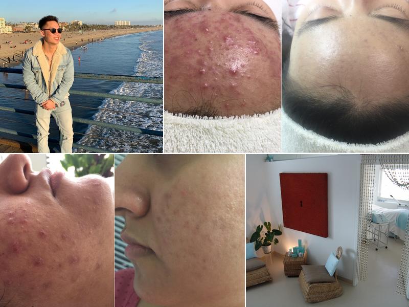 Acne Treatment SF
