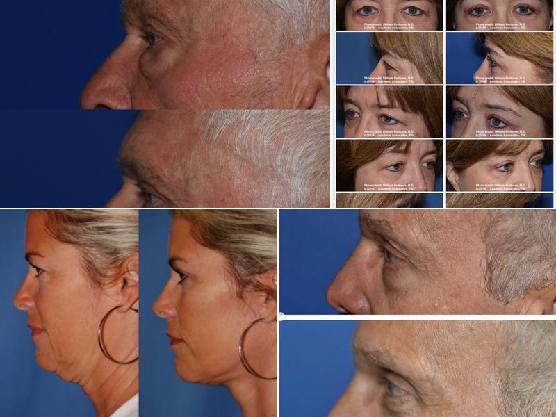 The Seattle Eyelid & Blepharoplasty Center