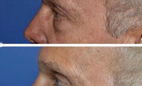 The Seattle Eyelid & Blepharoplasty Center