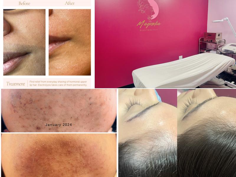 Magnolia Electrolysis Permanent Hair Removal