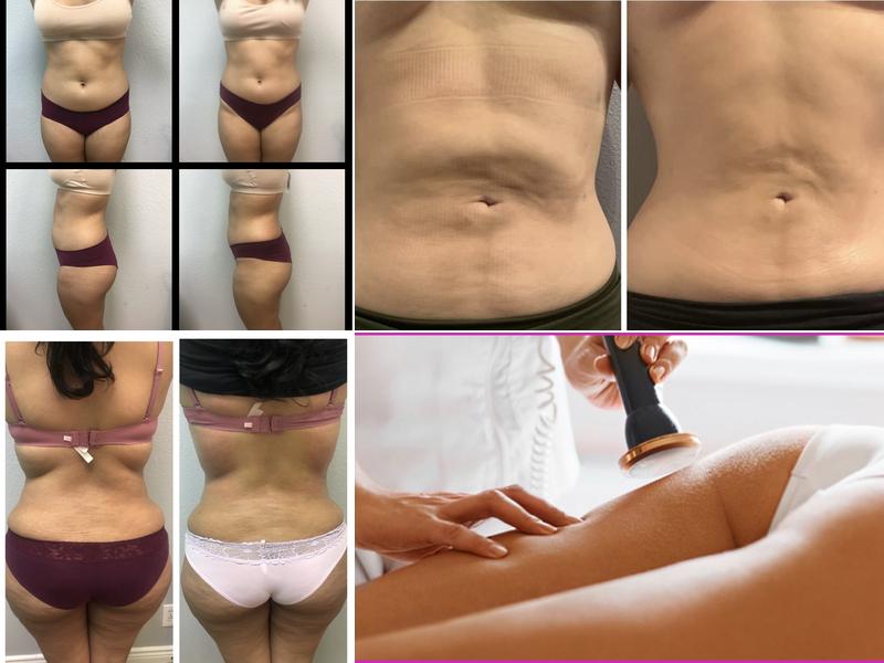 APL Body Sculpting
