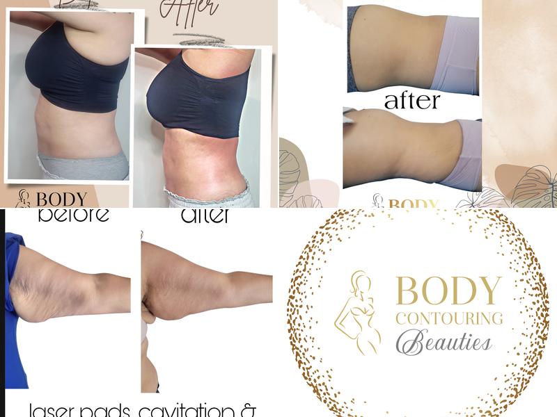 Body Contouring Beauties